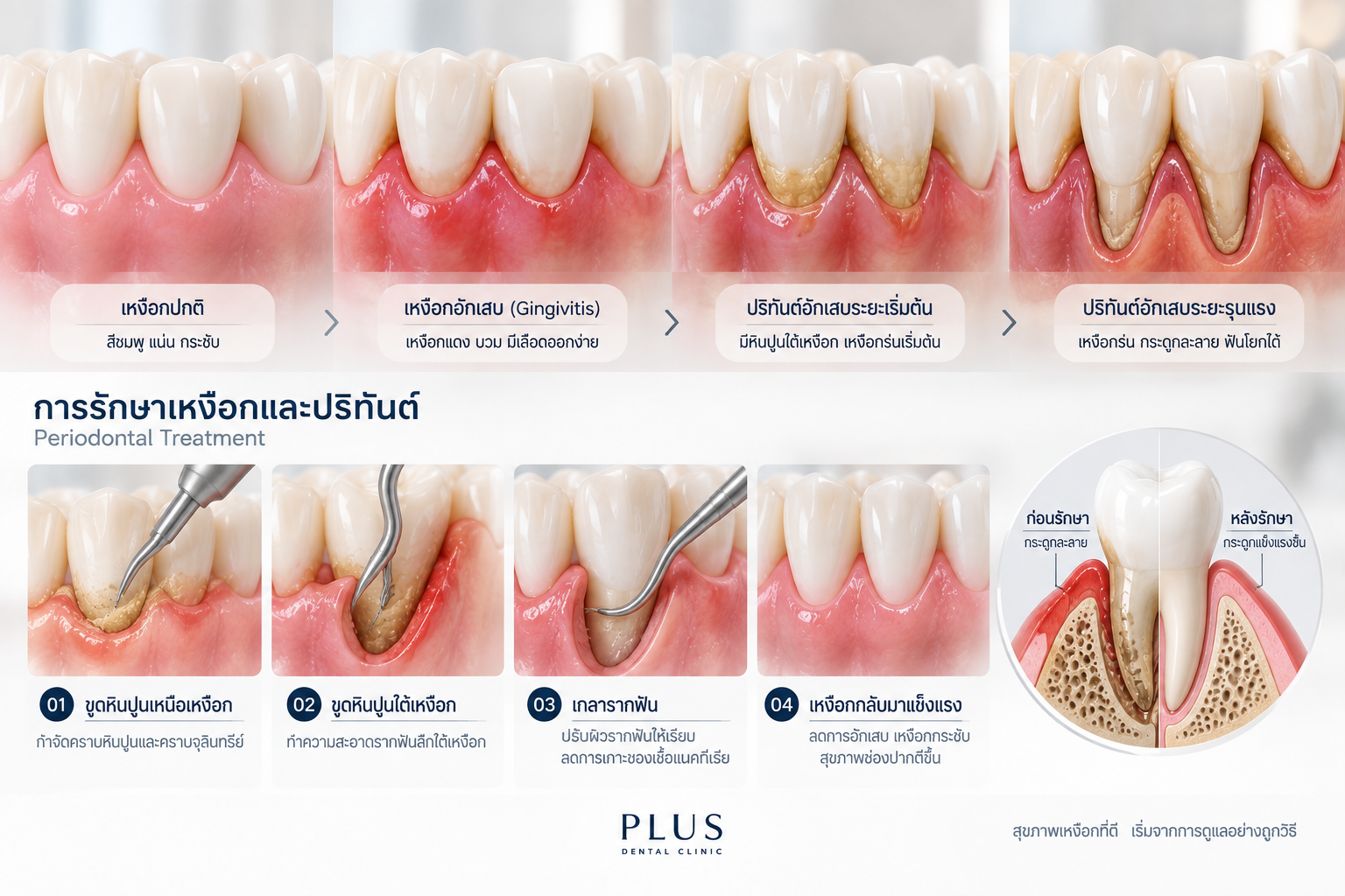 การทำความสะอาดบริเวณขอบเหงือกโดยผู้ให้การรักษา